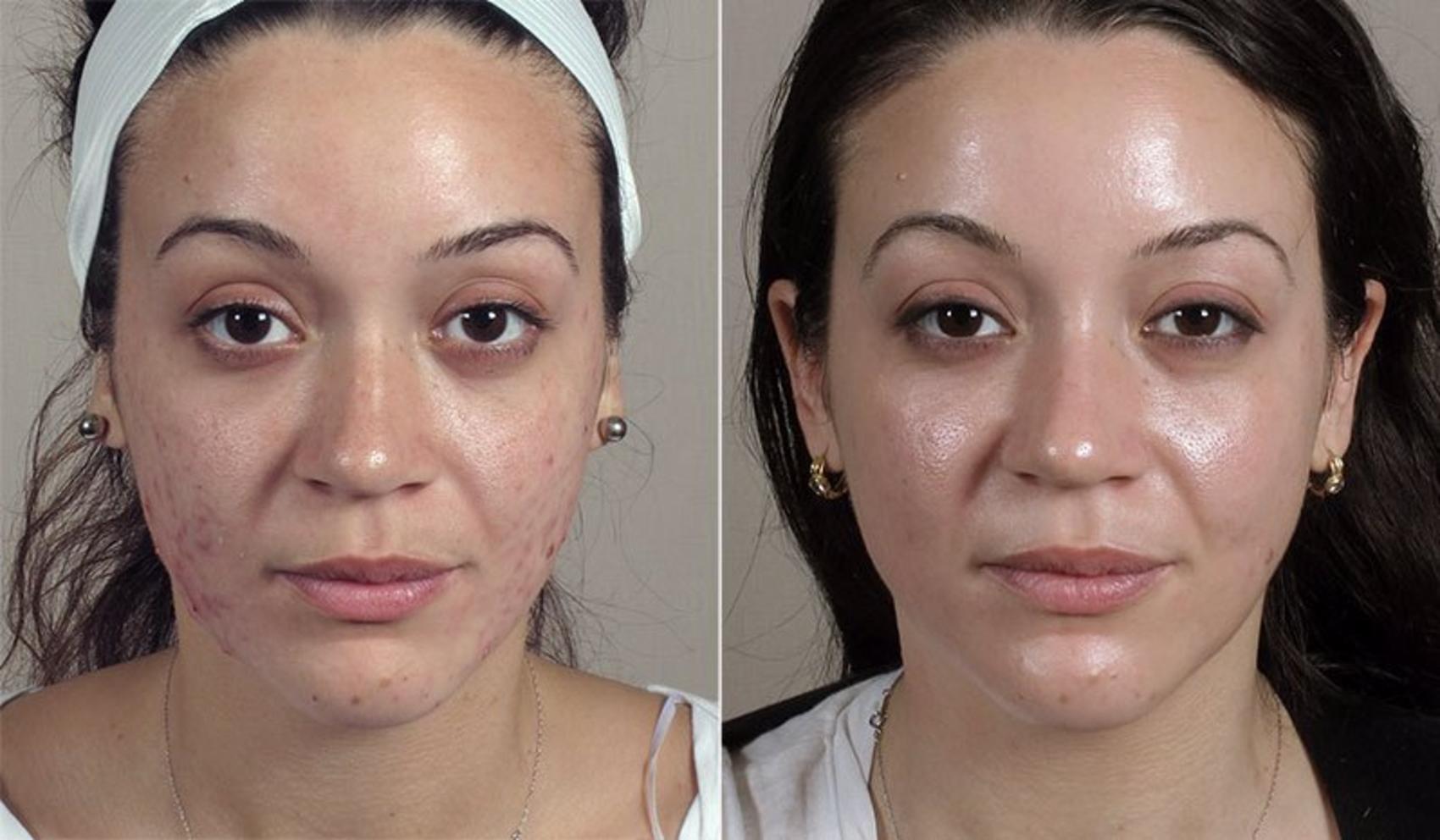 Advanced Acne Treatment Case 327 Before & After View #1 | Paramus, New Jersey | Parker Center for Plastic Surgery