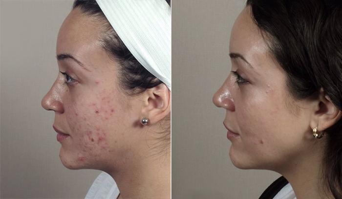 Advanced Acne Treatment Case 327 Before & After View #3 | Paramus, New Jersey | Parker Center for Plastic Surgery