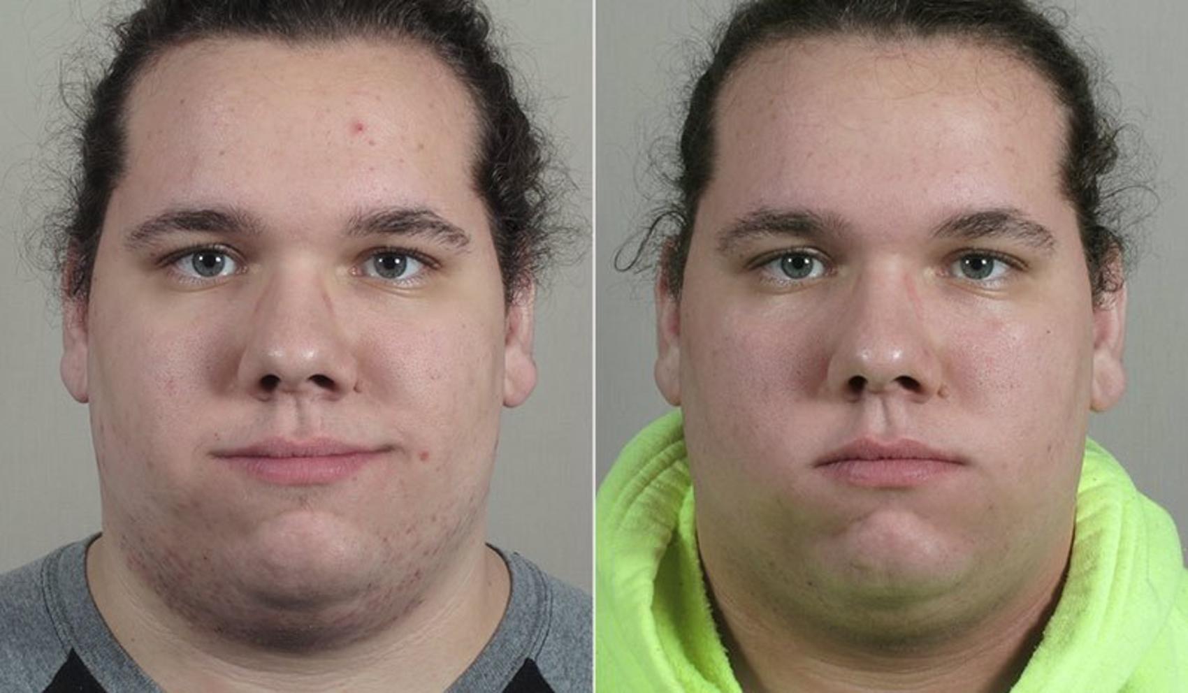 Advanced Acne Treatment Case 328 Before & After View #1 | Paramus, New Jersey | Parker Center for Plastic Surgery