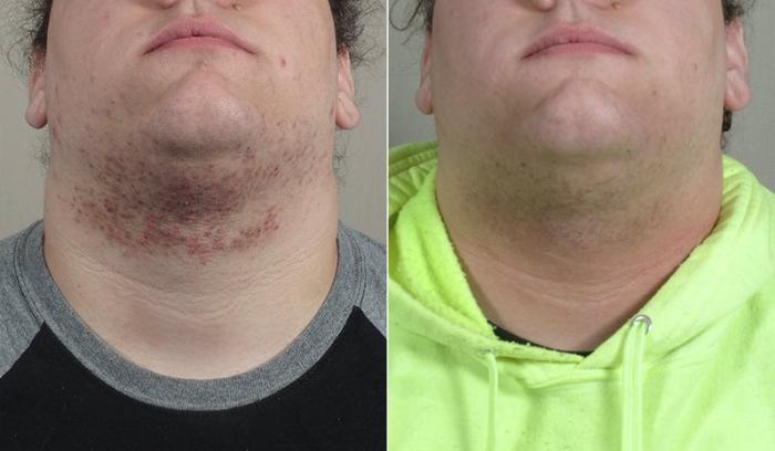Advanced Acne Treatment Case 328 Before & After View #2 | Paramus, New Jersey | Parker Center for Plastic Surgery