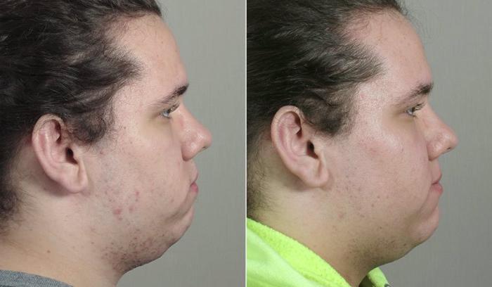 Advanced Acne Treatment Case 328 Before & After View #3 | Paramus, New Jersey | Parker Center for Plastic Surgery