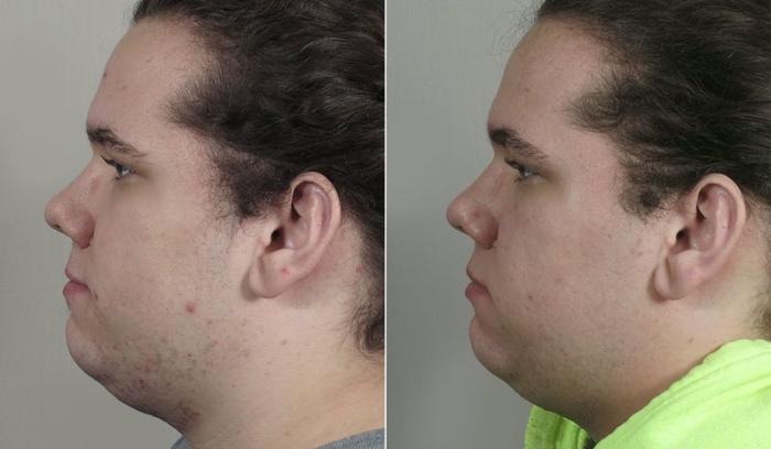 Advanced Acne Treatment Case 328 Before & After View #4 | Paramus, New Jersey | Parker Center for Plastic Surgery