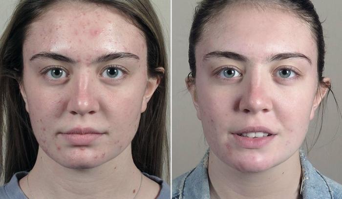 Advanced Acne Treatment Case 330 Before & After View #1 | Paramus, New Jersey | Parker Center for Plastic Surgery