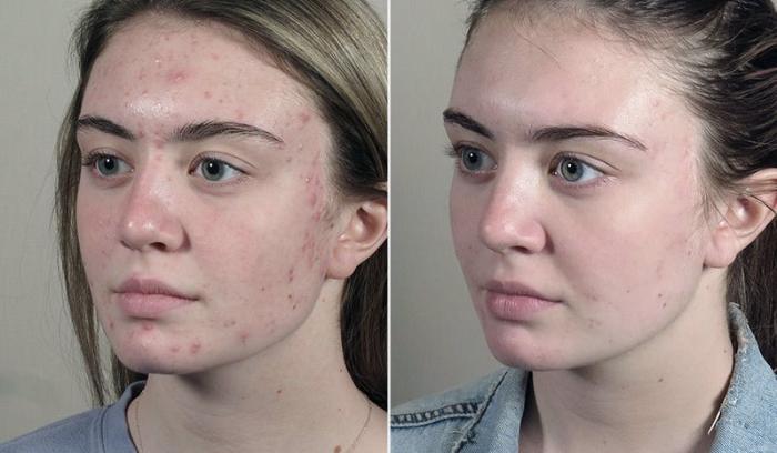 Advanced Acne Treatment Case 330 Before & After View #2 | Paramus, New Jersey | Parker Center for Plastic Surgery