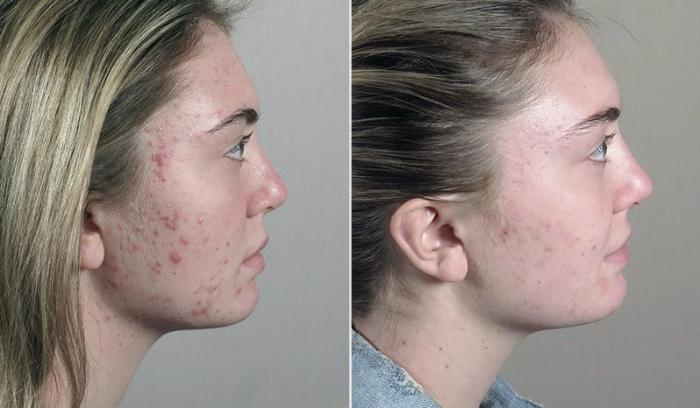 Advanced Acne Treatment Case 330 Before & After View #3 | Paramus, New Jersey | Parker Center for Plastic Surgery