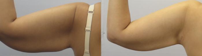 Arm Lift Case 1649 Before & After front 1 | Paramus, New Jersey | Parker Center for Plastic Surgery