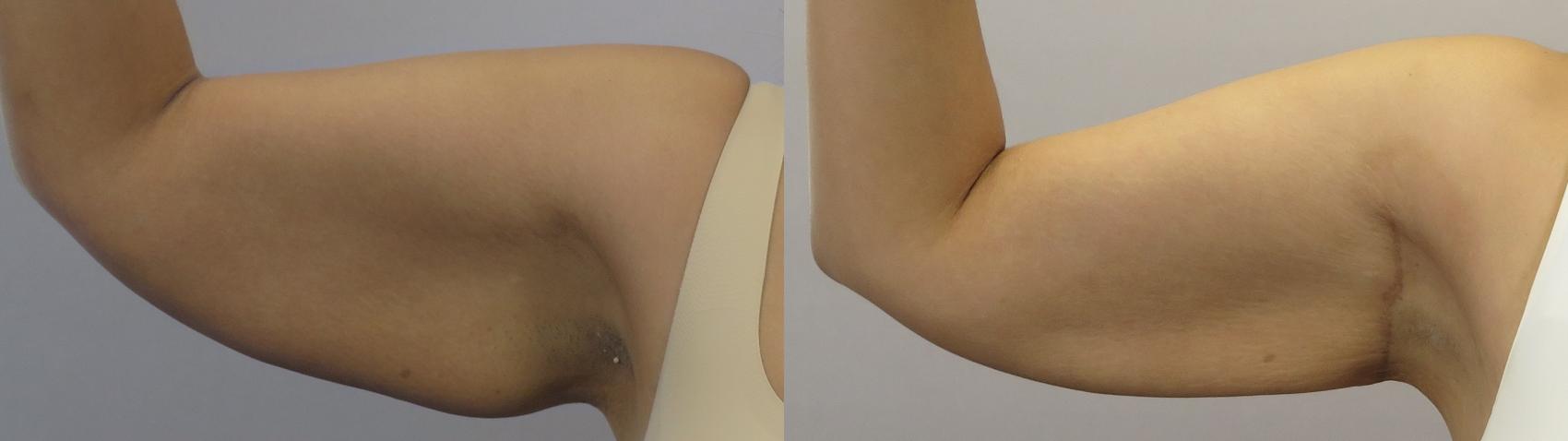 Arm Lift Case 1649 Before & After Left Side | Paramus, New Jersey | Parker Center for Plastic Surgery