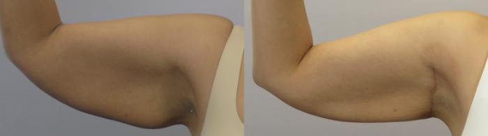 Arm Lift Case 1649 Before & After Left Side | Paramus, New Jersey | Parker Center for Plastic Surgery