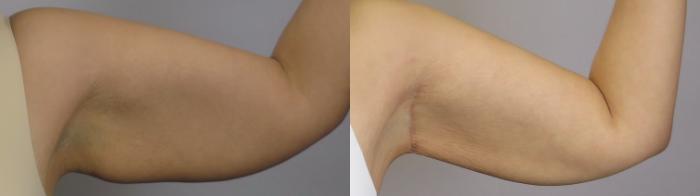 Arm Lift Case 1649 Before & After Right Side | Paramus, New Jersey | Parker Center for Plastic Surgery