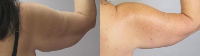 Arm Lift Case 1670 Before & After back 2 | Paramus, New Jersey | Parker Center for Plastic Surgery