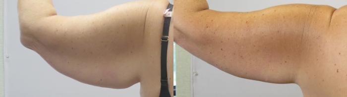 Arm Lift Case 1670 Before & After Back | Paramus, New Jersey | Parker Center for Plastic Surgery