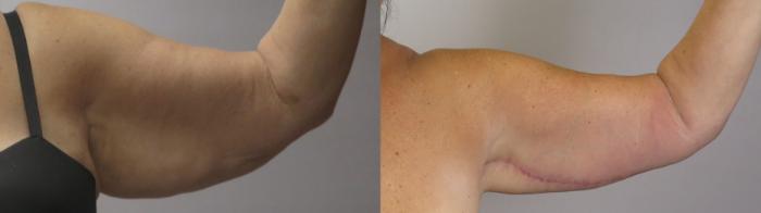 Arm Lift Case 1670 Before & After front 1 | Paramus, New Jersey | Parker Center for Plastic Surgery