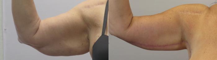 Arm Lift Case 1670 Before & After Front | Paramus, New Jersey | Parker Center for Plastic Surgery