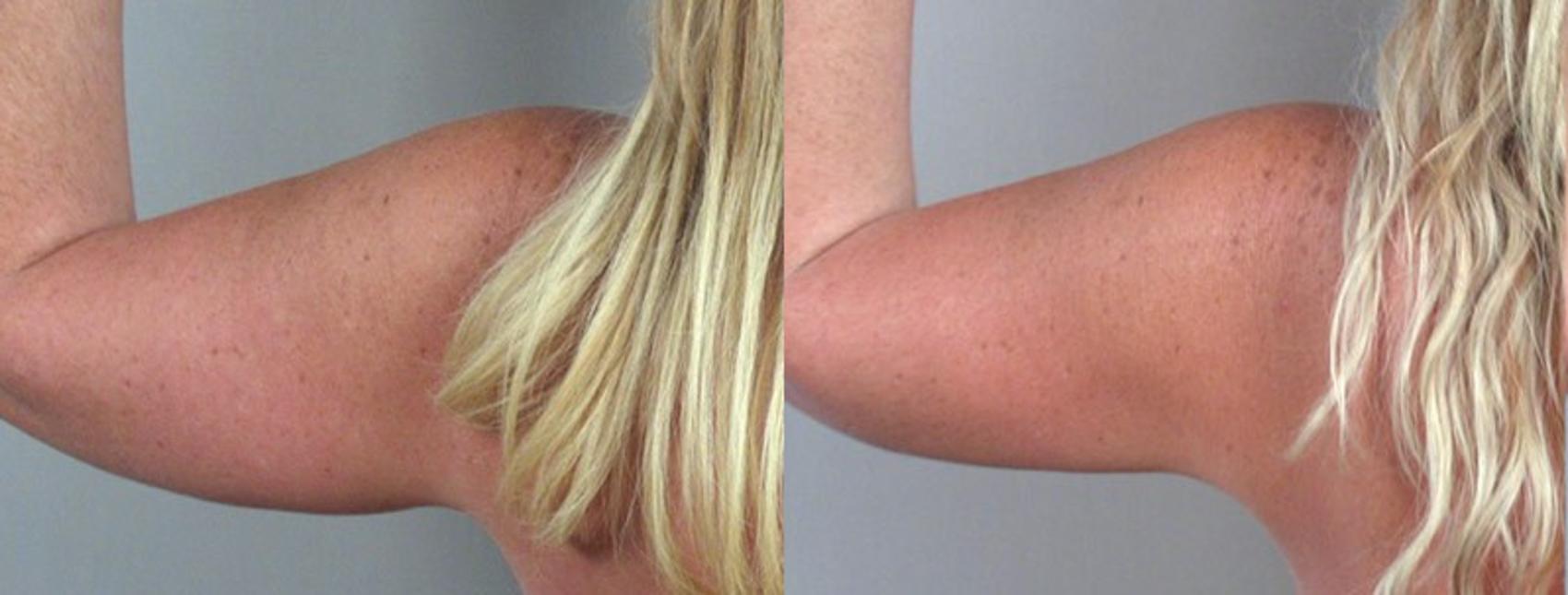 Arm Liposuction Case 824 Before & After View #3 | Paramus, New Jersey | Parker Center for Plastic Surgery