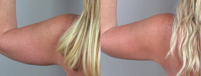 Arm Liposuction Case 824 Before & After View #3 | Paramus, New Jersey | Parker Center for Plastic Surgery