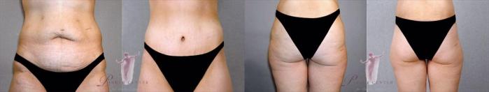 Body Lift Case 1165 Before & After Front | Paramus, New Jersey | Parker Center for Plastic Surgery