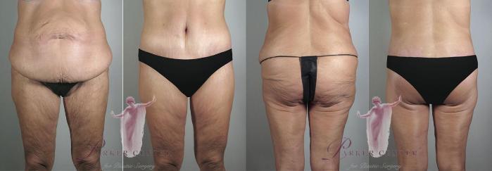 Body Lift Case 1166 Before & After Front | Paramus, New Jersey | Parker Center for Plastic Surgery