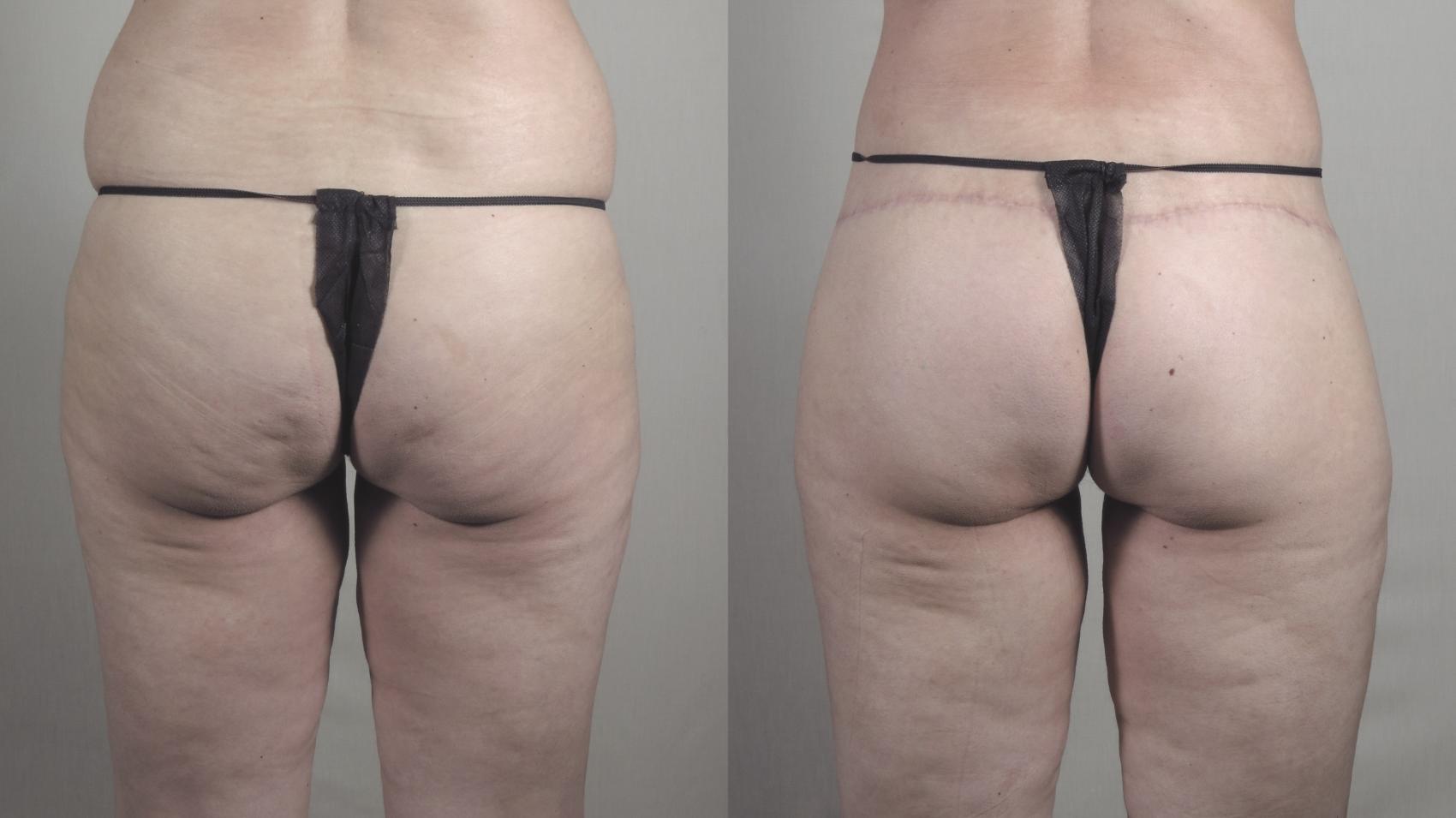 Body Lift Case 1276 Before & After Back | Paramus, New Jersey | Parker Center for Plastic Surgery