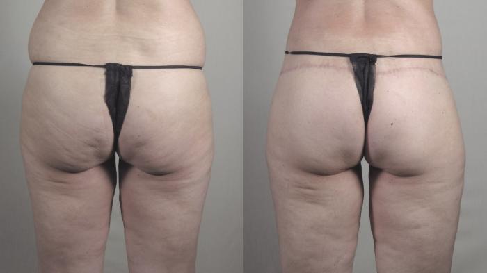 Body Lift Case 1276 Before & After Back | Paramus, New Jersey | Parker Center for Plastic Surgery