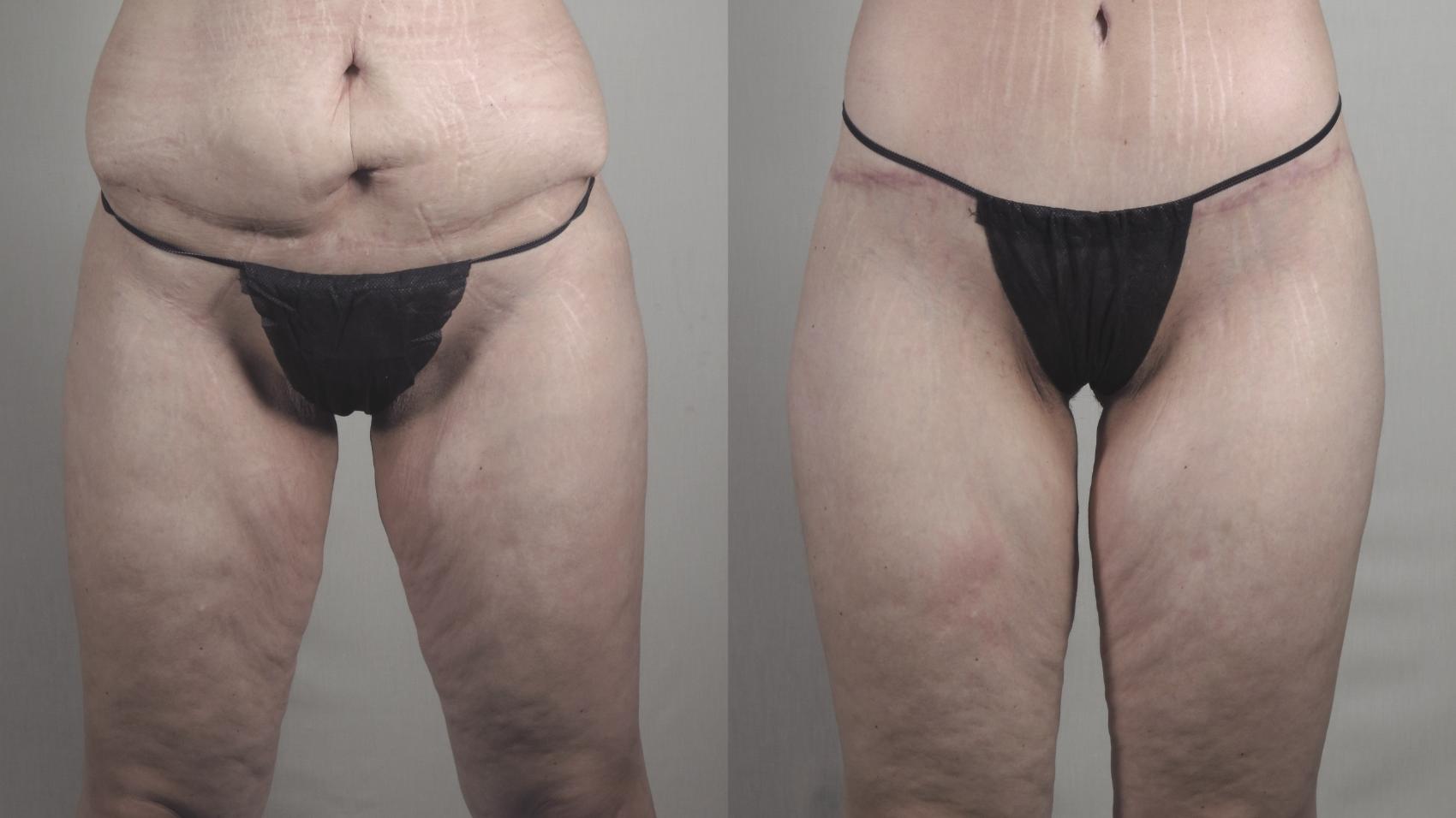 Body Lift Case 1276 Before & After Front | Paramus, New Jersey | Parker Center for Plastic Surgery