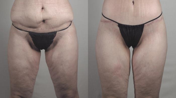 Body Lift Case 1276 Before & After Front | Paramus, New Jersey | Parker Center for Plastic Surgery