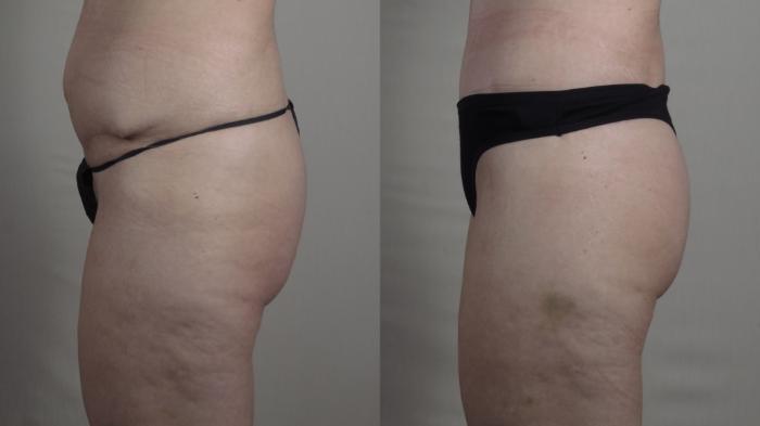 Body Lift Case 1276 Before & After Left Side | Paramus, New Jersey | Parker Center for Plastic Surgery