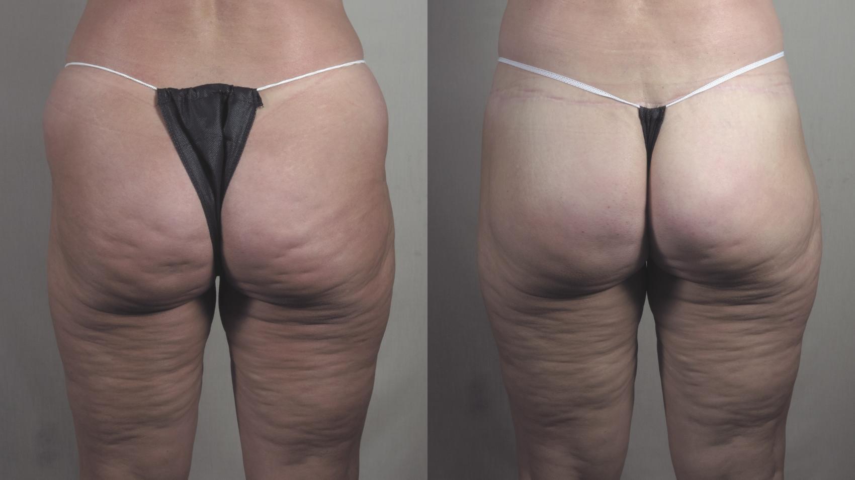 Body Lift Case 1277 Before & After Back | Paramus, New Jersey | Parker Center for Plastic Surgery