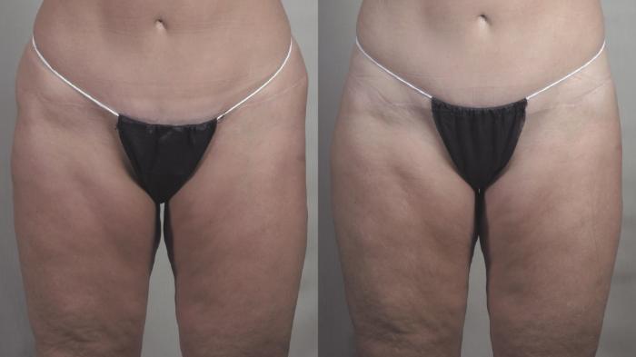 Body Lift Case 1277 Before & After Front | Paramus, New Jersey | Parker Center for Plastic Surgery
