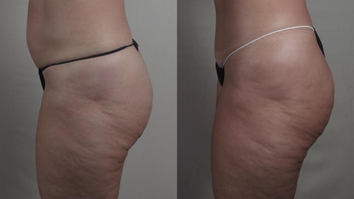 Body Lift Case 1277 Before & After Left Side | Paramus, New Jersey | Parker Center for Plastic Surgery