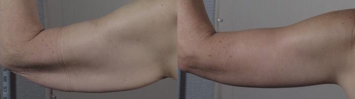 Body Lift Case 1302 Before & After back  | Paramus, New Jersey | Parker Center for Plastic Surgery