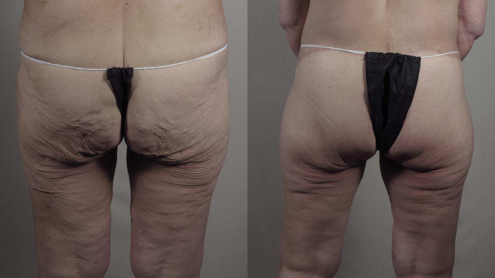 Body Lift Case 1302 Before & After Back | Paramus, New Jersey | Parker Center for Plastic Surgery