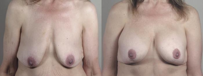 Body Lift Case 1302 Before & After front  | Paramus, New Jersey | Parker Center for Plastic Surgery