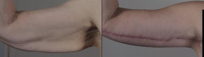 Body Lift Case 1302 Before & After front arms  | Paramus, New Jersey | Parker Center for Plastic Surgery