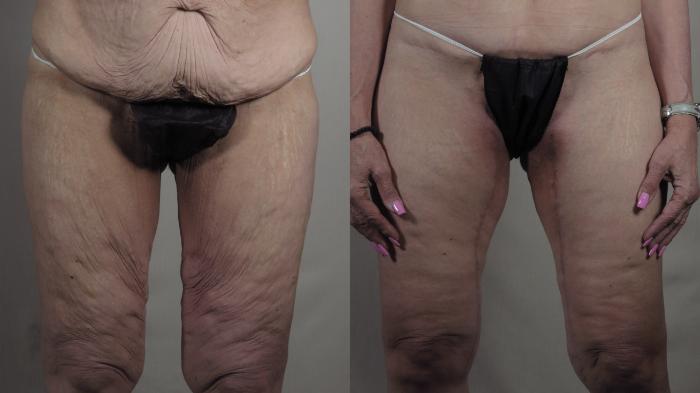 Body Lift Case 1302 Before & After front2 | Paramus, New Jersey | Parker Center for Plastic Surgery