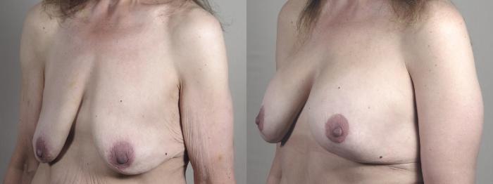 Body Lift Case 1302 Before & After Left Oblique | Paramus, New Jersey | Parker Center for Plastic Surgery
