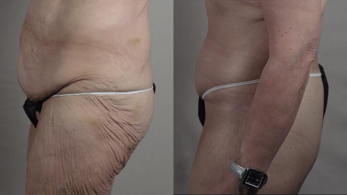 Body Lift Case 1302 Before & After Left Side | Paramus, New Jersey | Parker Center for Plastic Surgery