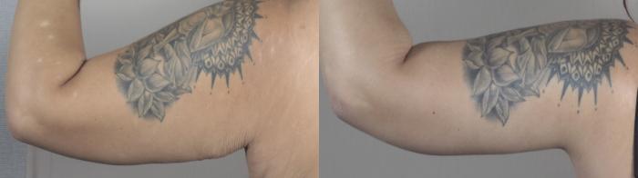 Body Lift Case 1321 Before & After back1 | Paramus, New Jersey | Parker Center for Plastic Surgery