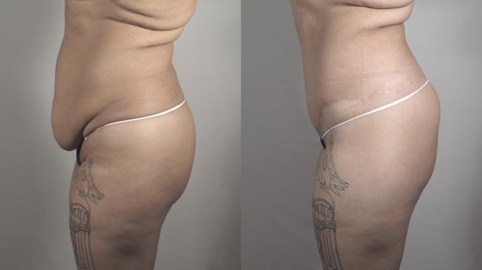 Body Lift Case 1321 Before & After Left Side | Paramus, New Jersey | Parker Center for Plastic Surgery