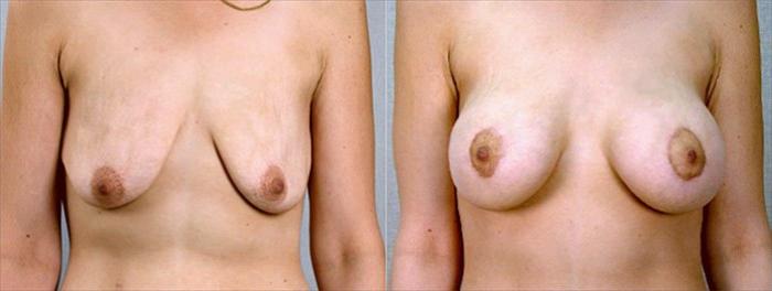 Body Lift Case 448 Before & After View #1 | Paramus, New Jersey | Parker Center for Plastic Surgery