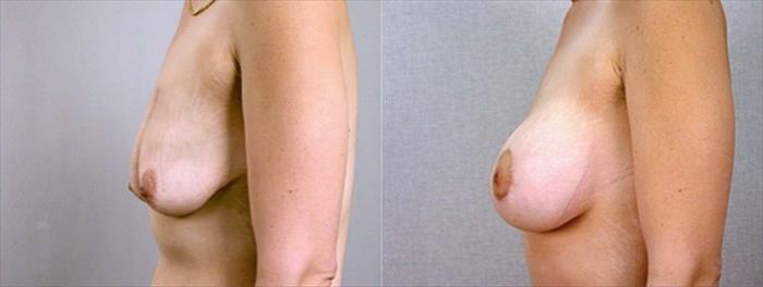 Body Lift Case 448 Before & After View #2 | Paramus, New Jersey | Parker Center for Plastic Surgery