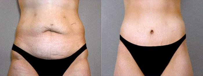 Body Lift Case 448 Before & After View #3 | Paramus, New Jersey | Parker Center for Plastic Surgery