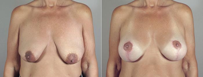 Body Lift Case 467 Before & After View #1 | Paramus, New Jersey | Parker Center for Plastic Surgery