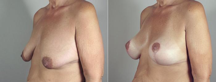 Body Lift Case 467 Before & After View #2 | Paramus, New Jersey | Parker Center for Plastic Surgery