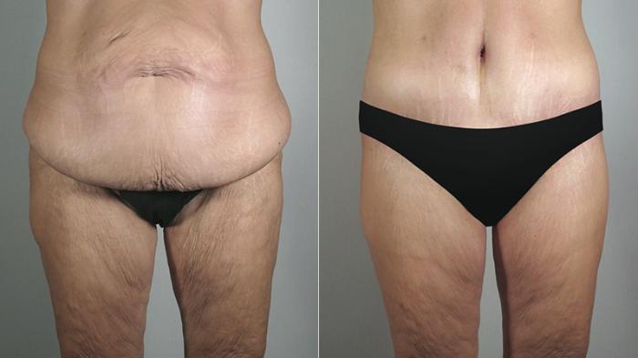 Body Lift Case 467 Before & After View #3 | Paramus, New Jersey | Parker Center for Plastic Surgery