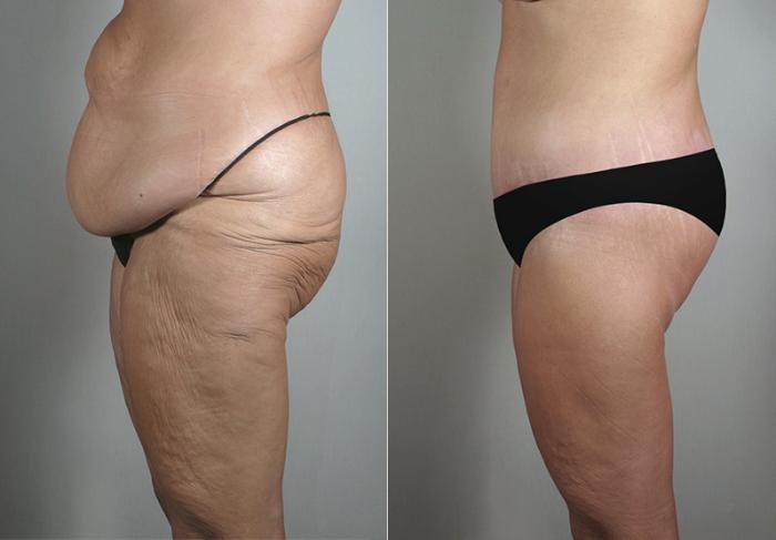 Body Lift Case 467 Before & After View #4 | Paramus, New Jersey | Parker Center for Plastic Surgery