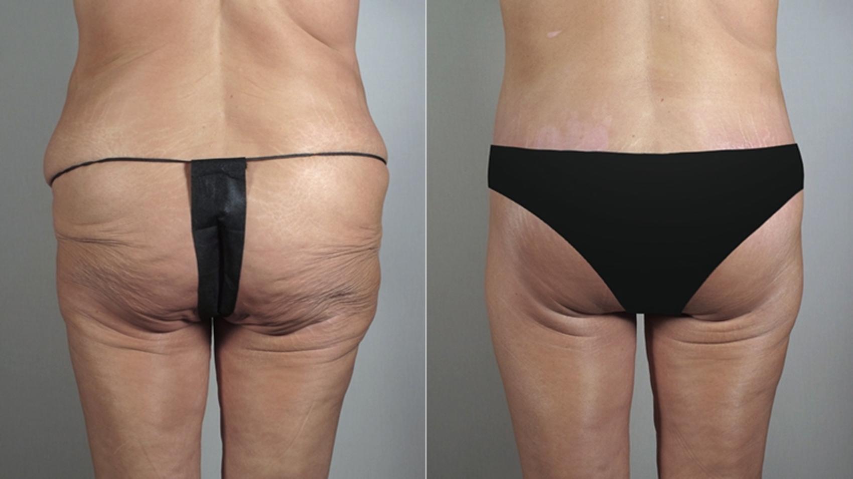 Body Lift Case 467 Before & After View #5 | Paramus, New Jersey | Parker Center for Plastic Surgery