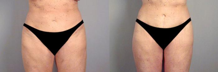 Body Lift Case 714 Before & After View #1 | Paramus, New Jersey | Parker Center for Plastic Surgery