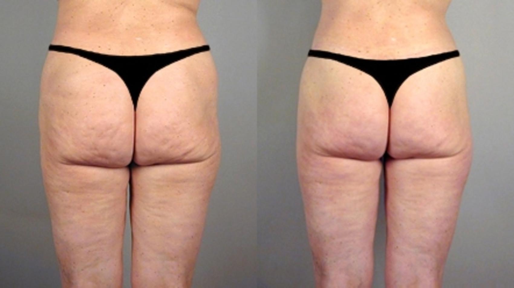 Body Lift Case 714 Before & After View #2 | Paramus, New Jersey | Parker Center for Plastic Surgery