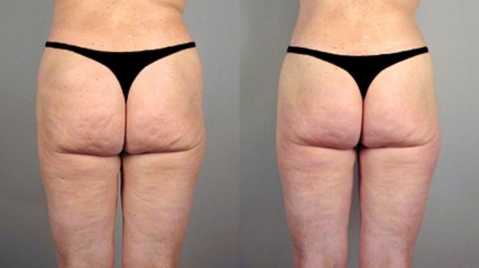 Body Lift Case 714 Before & After View #2 | Paramus, New Jersey | Parker Center for Plastic Surgery