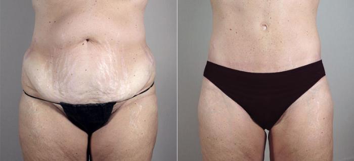 Body Lift Case 722 Before & After View #1 | Paramus, New Jersey | Parker Center for Plastic Surgery